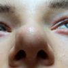 Wtórna korekta czubka nosa oraz powiększenie ust - 10477