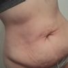 Operacja brzucha po zrzuceniu 50 kg