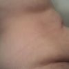 Operacja brzucha po zrzuceniu 50 kg