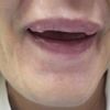 Grudki po wypełnieniu ust kwasem hialuronowym