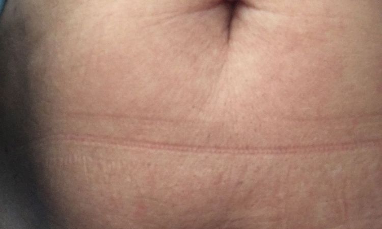 Po liposukcji laserowej brzucha - nierówności - 10585