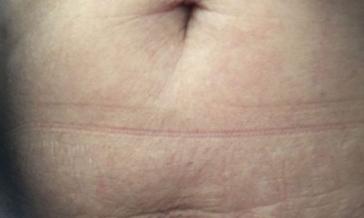 Po liposukcji laserowej brzucha - nierówności - 10586