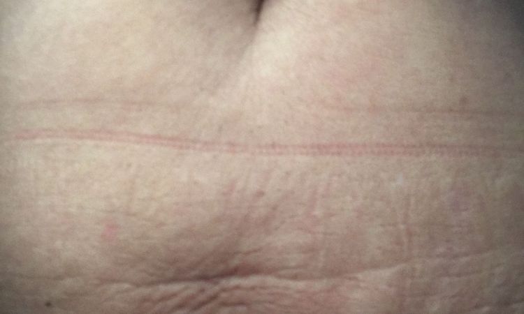 Po liposukcji laserowej brzucha - nierówności - 10587