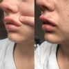 Opadające kąciki ust po powiększeniu kwasem