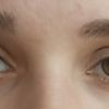 Zmiana kształtu oczu - kantoplastyka - 10613