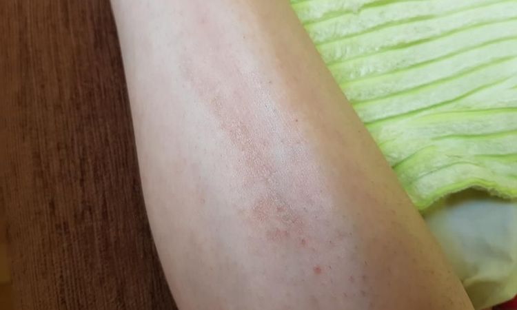 Usuwanie blizny po goleniu na nodze - 10647
