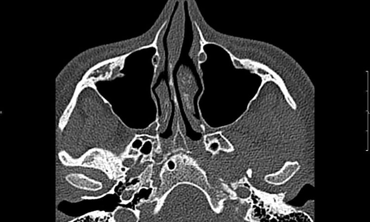 Rhinoplastyka, septoplastyka oraz konchoplastyka - 10660