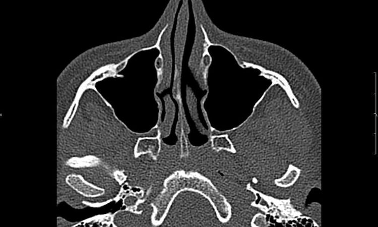 Rhinoplastyka, septoplastyka oraz konchoplastyka - 10662