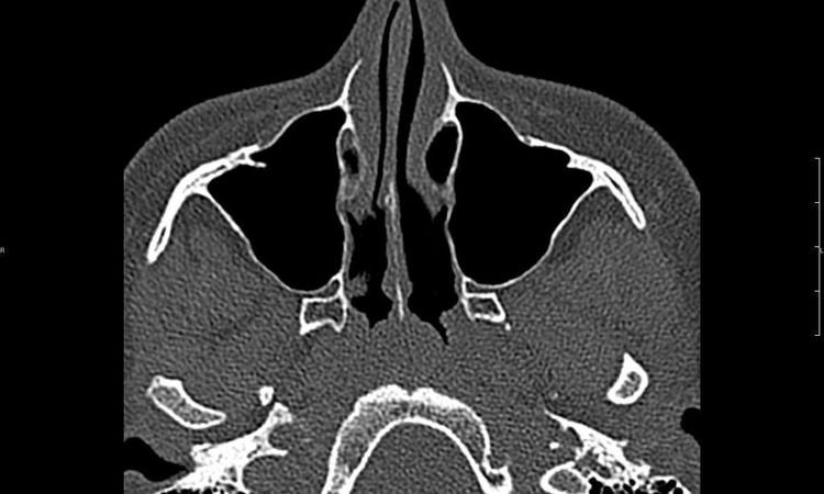 Rhinoplastyka, septoplastyka oraz konchoplastyka - 10664