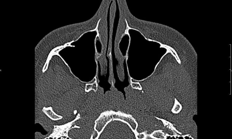 Rhinoplastyka, septoplastyka oraz konchoplastyka - 10665