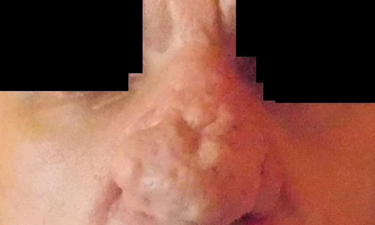 Rhinophyma guzowatość nosa - laserowe usuwanie - 10698