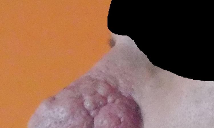 Rhinophyma guzowatość nosa - laserowe usuwanie - 10700