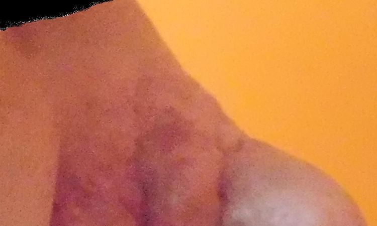 Rhinophyma guzowatość nosa - laserowe usuwanie - 10701