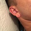 Zmniejszenie płatków ucha - 10719