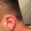 Zmniejszenie płatków ucha - 10721