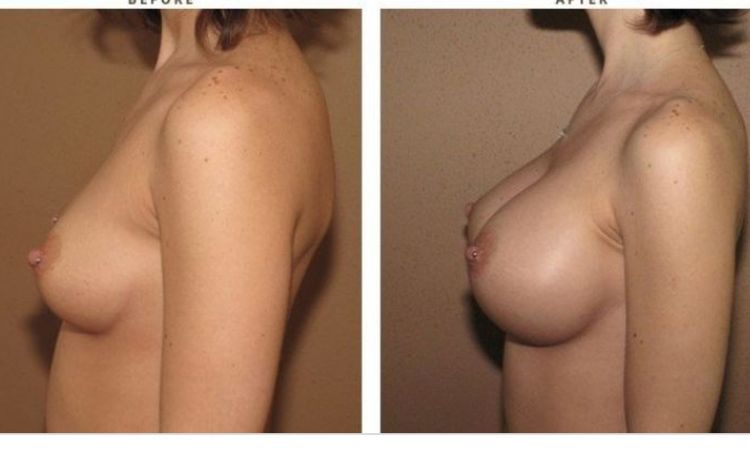 Czy z implantami anatomicznymi 375 uzyskam taki efekt? - 10732