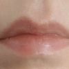 Zlikwidowanie asymetrii i powiększenie ust kwasem hialuronowym 