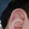 Rozszerzone naczynka na uchu - czy laser pomoże? - 10788