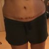 Liposukcja boczków po plastyce brzucha