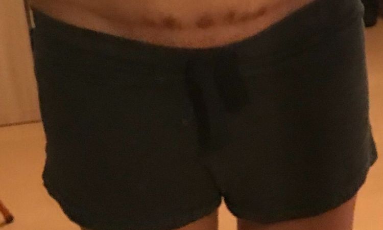 Liposukcja boczków po plastyce brzucha - 10837