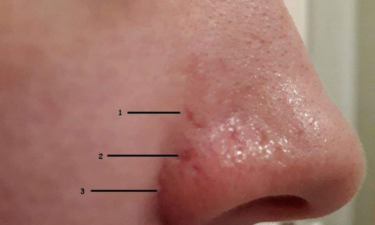 Blizny po laserze na zamykanie naczynek na nosie - 10845