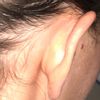 Korekta odstajacych uszu bez efektu przyklejenia do czaszki - 10852