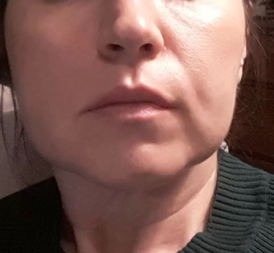 Opadający dół twarzy, ciężka nalana kwadratowa twarz - czy możliwe jest osiągnie