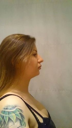Liposukcja podbródka - chcę zlikwidować podwójny podbródek