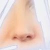 Nos pourazowy- możliwości korekcji nosa po urazie - 10895