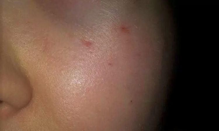 Czerwone przebarwienia po laserowym zamykaniu naczynek - 10916