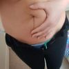 Liposukcja czy plastyka brzucha? Brzuch po dwóch ciążach - 10930