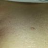 Dziwny pieprzyk - czy może być niebezpieczny?