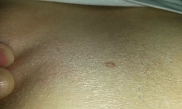 Dziwny pieprzyk - czy może być niebezpieczny? - 10936