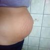 Brzuch po ciąży - wystarczą ćwiczenia czy potrzebna operacja?
