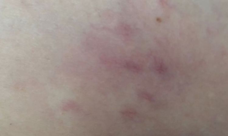 Skleroterapia niepokojące objawy po zabiegu - 10988