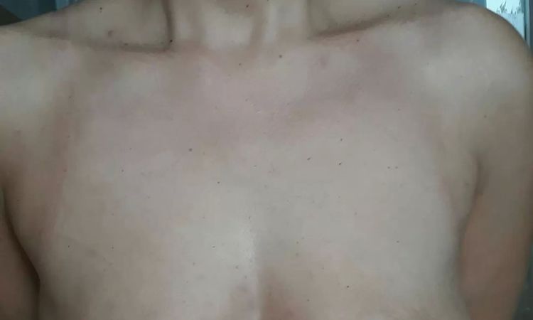 Podniesienie biustu tylko za pomocą implantów? - 11005