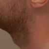 Czy kwas hialuronowy pomoże uwydatnić moją brodę?
