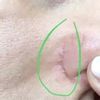 Redukcja blizn po operacji nosa - 11019