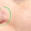 Redukcja blizn po operacji nosa - 11022