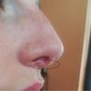 Zabieg usunięcia wystającej podstawy nosa - 11030