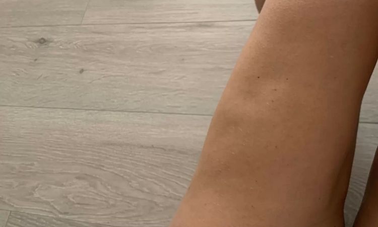 Kiedy można wykonać ponownie liposukcję? - 11035