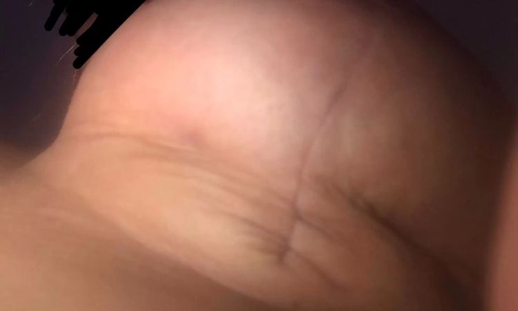 Piersi 7 tygodni po operacji - czy wymagają poprawki? - 11043