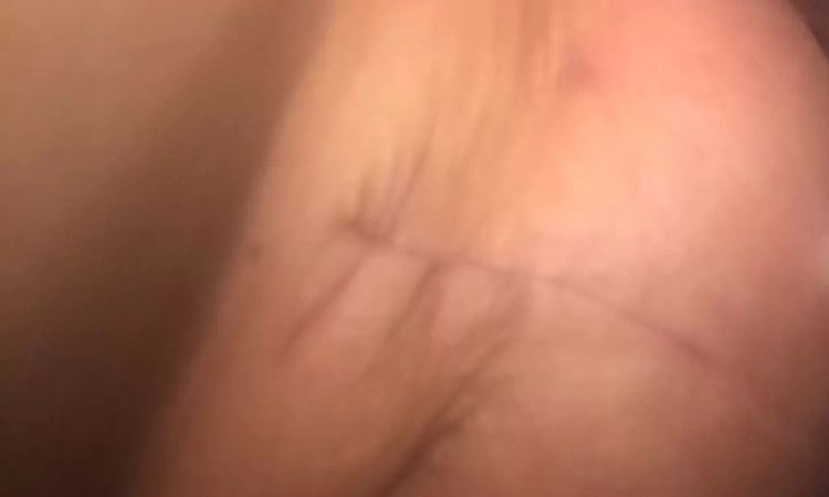 Piersi 7 tygodni po operacji - czy wymagają poprawki? - 11044