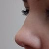 Wyszczuplenie szerokiego nosa za pomocą kwasu hialuronowego - 11071