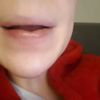 Grudki w ustach po powiększaniu - rozpuścić kwas czy dopełnić usta? - 11109