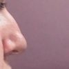Garb nosa - jaki efekt można osiągnąć poprzez spiłowanie garba? - 11110