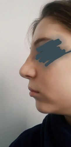 Korekta cofniętej brody kwasem