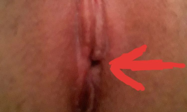 Ubytek tkanki po zbyt ciasnym szwie! - 11127