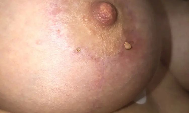 Ropienie rany - 11151
