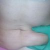 Liposukcja: niezadowolona z efektu :/ czy tak to ma wyglądać?